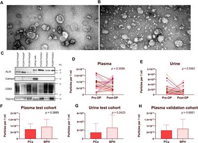 Validation of potential RNA biomarkers for prostate cancer diagnosis and monitoring in plasma and urinary extracellular vesicles